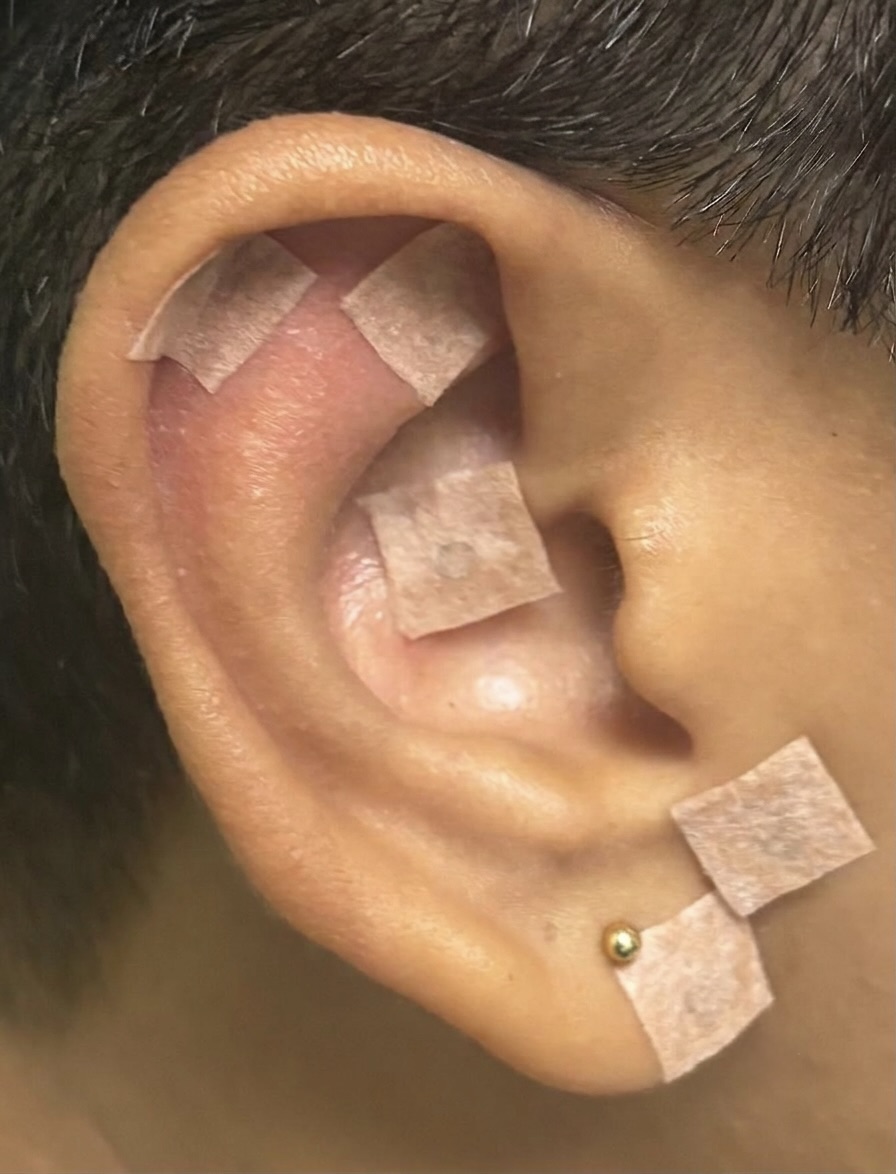 Auriculotherapy