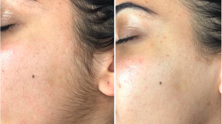 Basic Facial + Dermaplaning + Microdermabrasion
