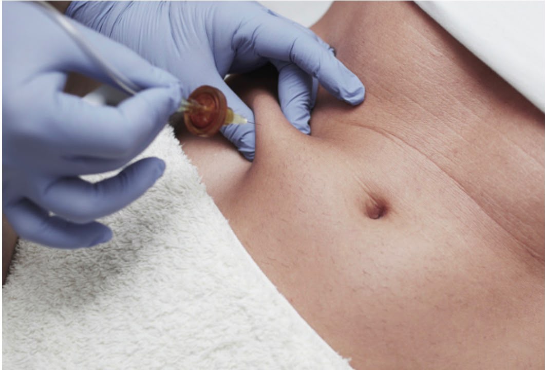Carboxytherapy